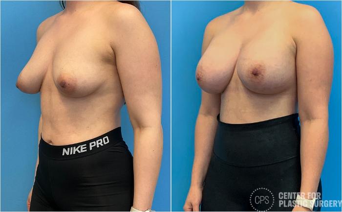 Breast Augmentation Case 417 Before & After Left Oblique | Chevy Chase & Annandale, Washington D.C. Metropolitan Area | Center for Plastic Surgery