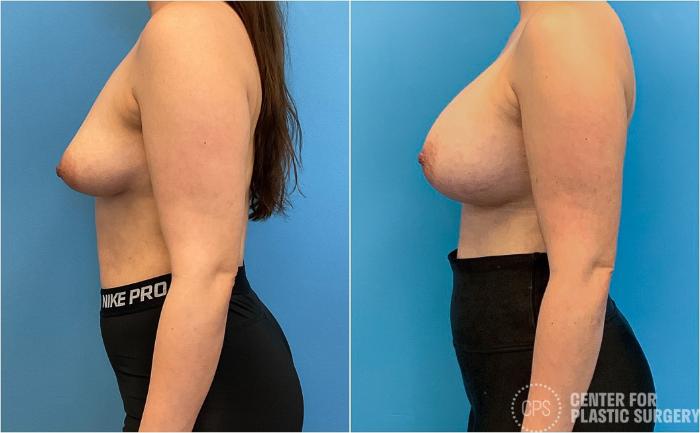 Breast Augmentation Case 417 Before & After Left Side | Chevy Chase & Annandale, Washington D.C. Metropolitan Area | Center for Plastic Surgery