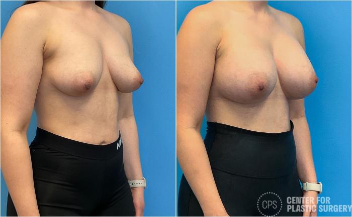 Breast Augmentation Case 417 Before & After Right Oblique | Chevy Chase & Annandale, Washington D.C. Metropolitan Area | Center for Plastic Surgery