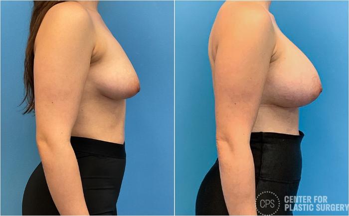Breast Augmentation Case 417 Before & After Right Side | Chevy Chase & Annandale, Washington D.C. Metropolitan Area | Center for Plastic Surgery