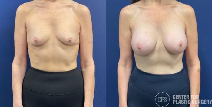Breast Augmentation Case 419 Before & After Front | Chevy Chase & Annandale, Washington D.C. Metropolitan Area | Center for Plastic Surgery