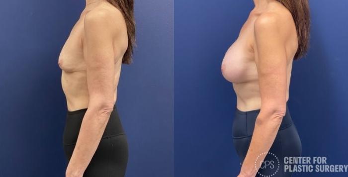 Breast Augmentation Case 419 Before & After Left Side | Chevy Chase & Annandale, Washington D.C. Metropolitan Area | Center for Plastic Surgery