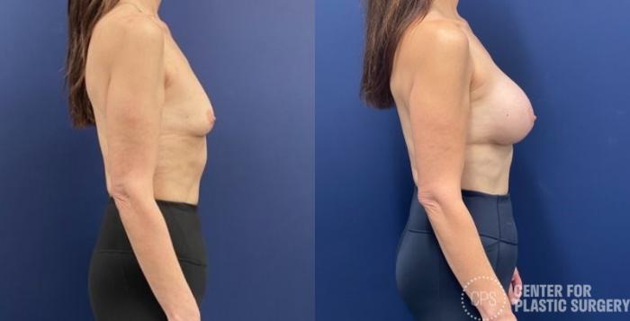Breast Augmentation Case 419 Before & After Right Side | Chevy Chase & Annandale, Washington D.C. Metropolitan Area | Center for Plastic Surgery