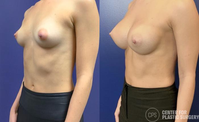 Breast Augmentation Case 421 Before & After Left Oblique | Chevy Chase & Annandale, Washington D.C. Metropolitan Area | Center for Plastic Surgery