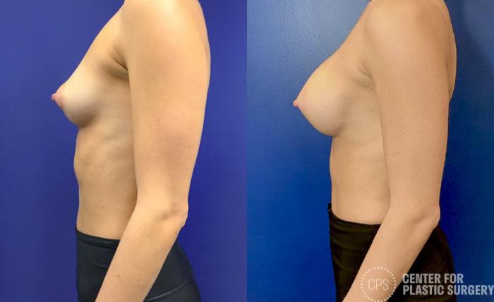 Breast Augmentation Case 421 Before & After Left Side | Chevy Chase & Annandale, Washington D.C. Metropolitan Area | Center for Plastic Surgery