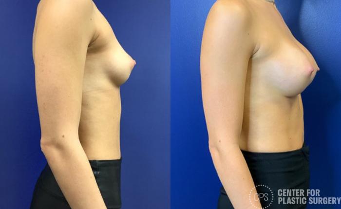 Breast Augmentation Case 421 Before & After Right Side | Chevy Chase & Annandale, Washington D.C. Metropolitan Area | Center for Plastic Surgery