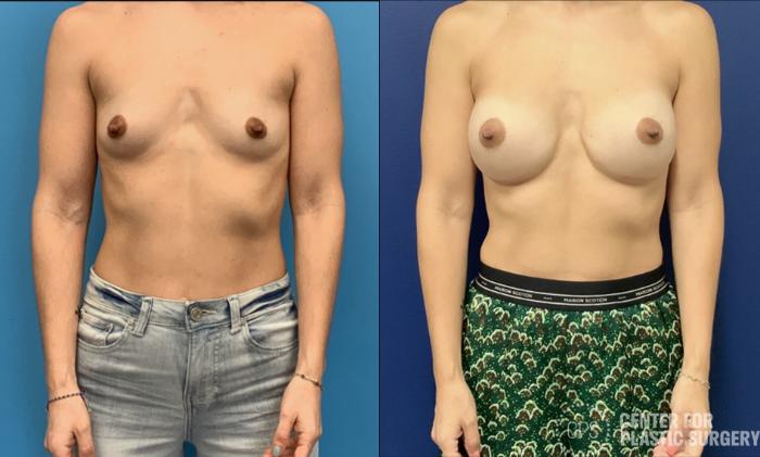 Breast Augmentation Case 422 Before & After Front | Chevy Chase & Annandale, Washington D.C. Metropolitan Area | Center for Plastic Surgery