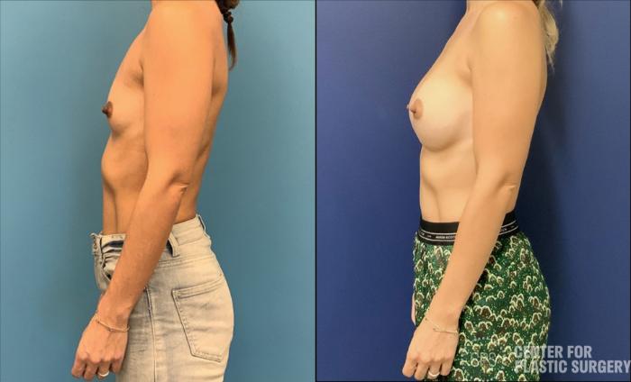 Breast Augmentation Case 422 Before & After Left Side | Chevy Chase & Annandale, Washington D.C. Metropolitan Area | Center for Plastic Surgery