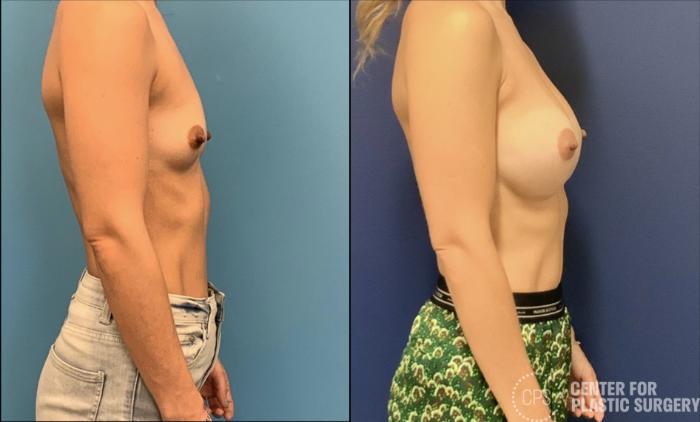 Breast Augmentation Case 422 Before & After Right Side | Chevy Chase & Annandale, Washington D.C. Metropolitan Area | Center for Plastic Surgery