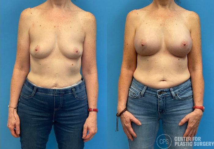 Breast Augmentation Case 425 Before & After Front | Chevy Chase & Annandale, Washington D.C. Metropolitan Area | Center for Plastic Surgery