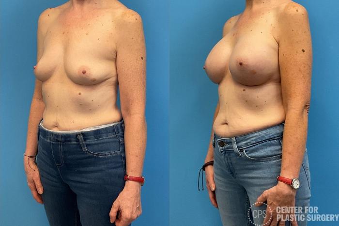 Breast Augmentation Case 425 Before & After Left Oblique | Chevy Chase & Annandale, Washington D.C. Metropolitan Area | Center for Plastic Surgery