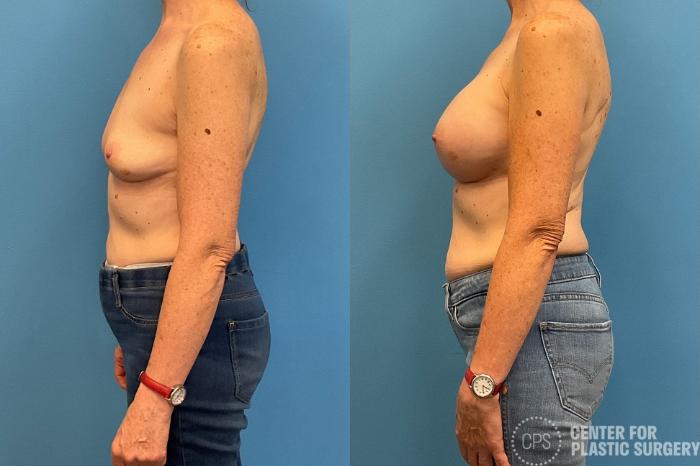 Breast Augmentation Case 425 Before & After Left Side | Chevy Chase & Annandale, Washington D.C. Metropolitan Area | Center for Plastic Surgery
