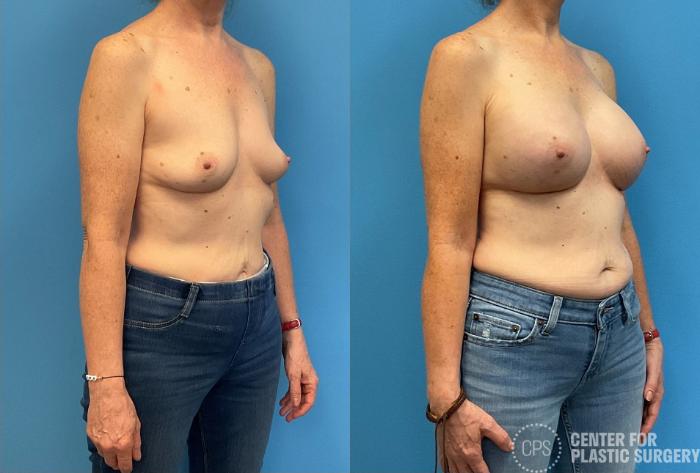 Breast Augmentation Case 425 Before & After Right Oblique | Chevy Chase & Annandale, Washington D.C. Metropolitan Area | Center for Plastic Surgery