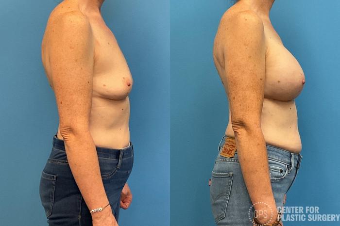 Breast Augmentation Case 425 Before & After Right Side | Chevy Chase & Annandale, Washington D.C. Metropolitan Area | Center for Plastic Surgery