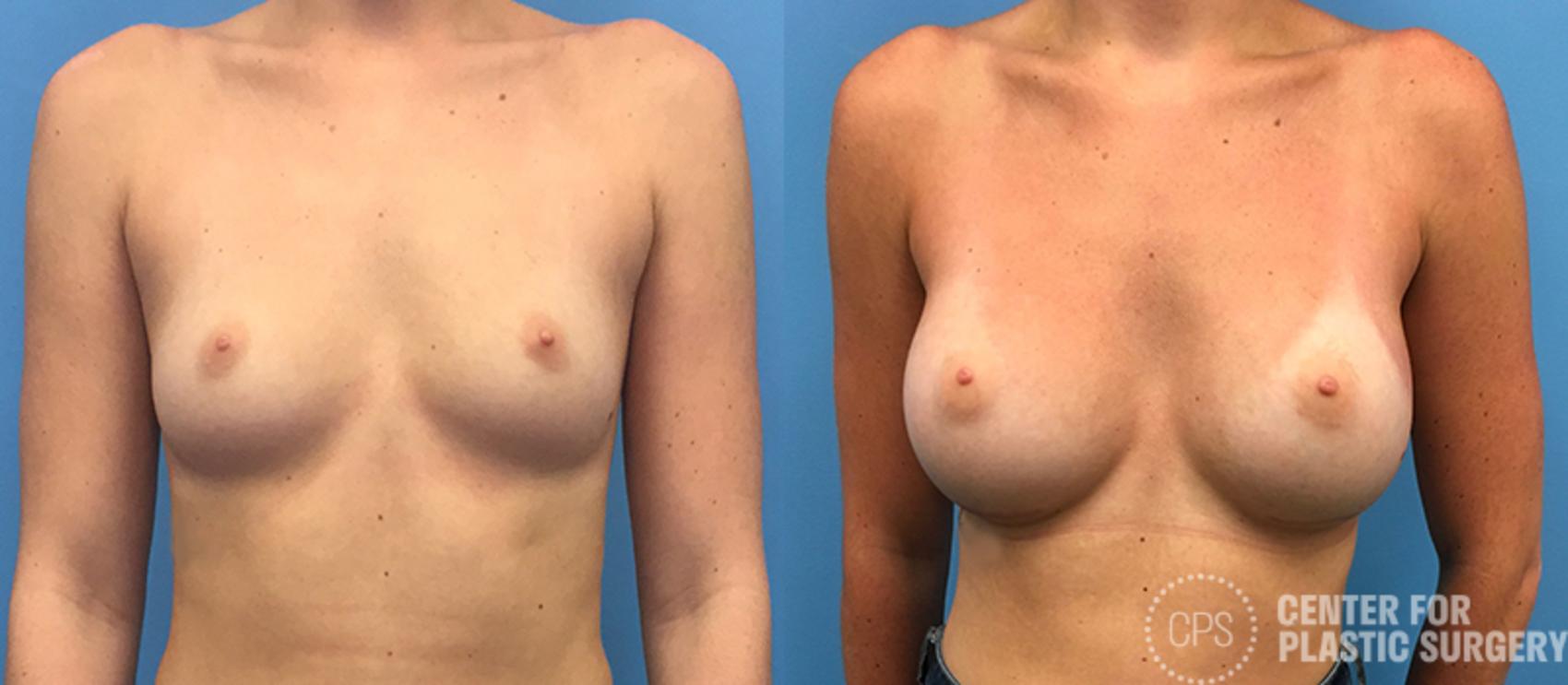Breast Augmentation Case 81 Before & After Front | Chevy Chase & Annandale, Washington D.C. Metropolitan Area | Center for Plastic Surgery