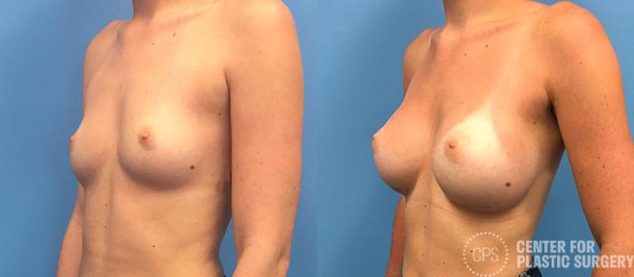 Breast Augmentation Case 81 Before & After Left Oblique | Chevy Chase & Annandale, Washington D.C. Metropolitan Area | Center for Plastic Surgery