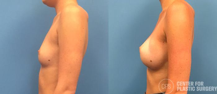 Breast Augmentation Case 81 Before & After Left Side | Chevy Chase & Annandale, Washington D.C. Metropolitan Area | Center for Plastic Surgery