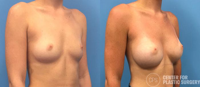 Breast Augmentation Case 81 Before & After Right Oblique | Chevy Chase & Annandale, Washington D.C. Metropolitan Area | Center for Plastic Surgery