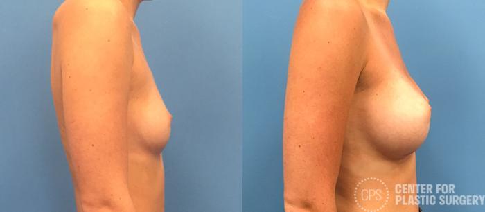Breast Augmentation Case 81 Before & After Right Side | Chevy Chase & Annandale, Washington D.C. Metropolitan Area | Center for Plastic Surgery