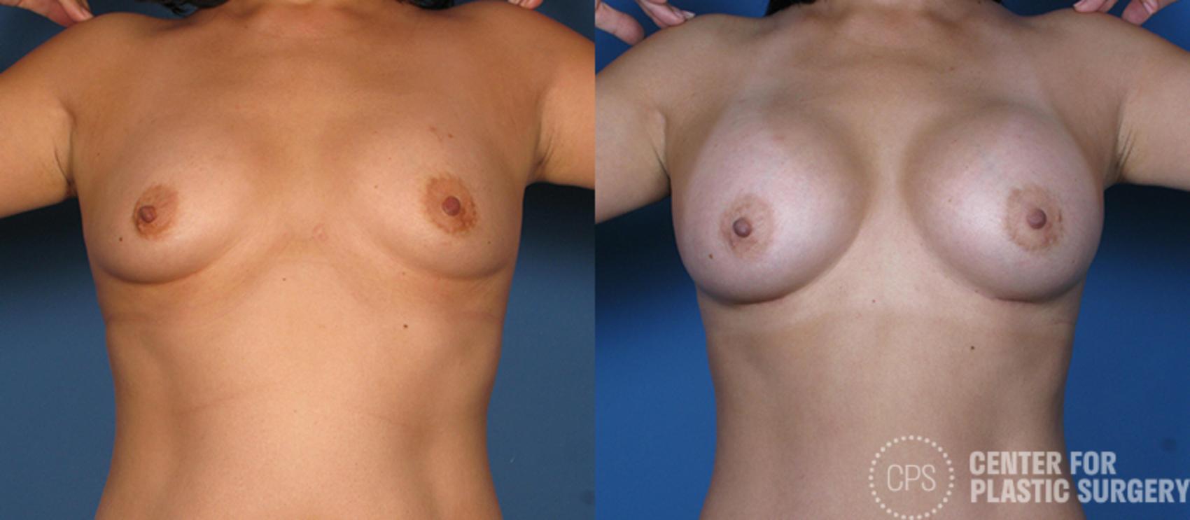 Breast Augmentation Case 82 Before & After Front | Chevy Chase & Annandale, Washington D.C. Metropolitan Area | Center for Plastic Surgery