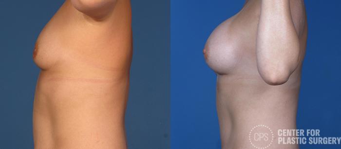 Breast Augmentation Case 82 Before & After Left Side | Chevy Chase & Annandale, Washington D.C. Metropolitan Area | Center for Plastic Surgery