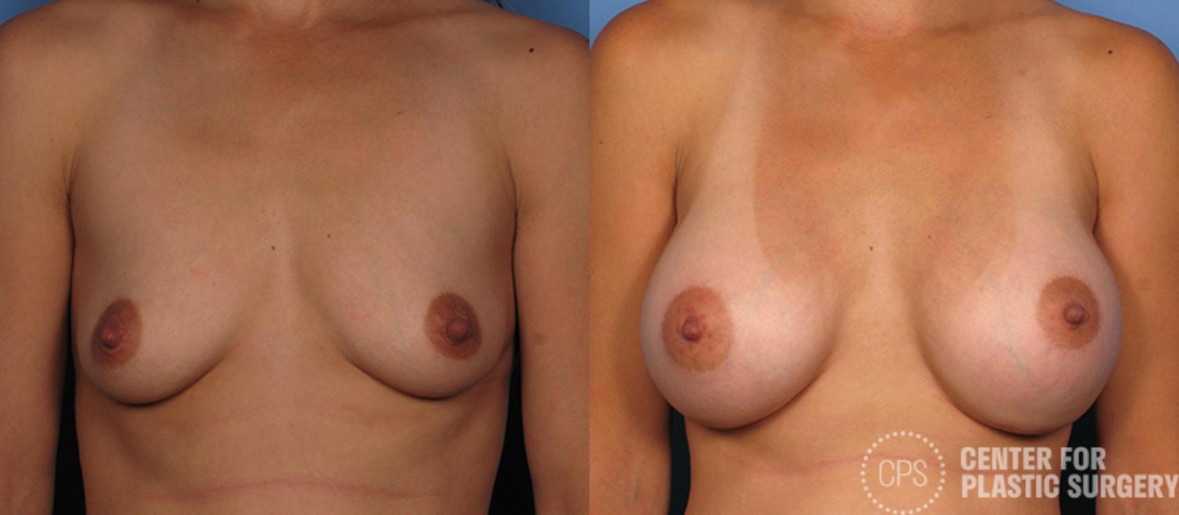 Breast Augmentation Case 83 Before & After Front | Chevy Chase & Annandale, Washington D.C. Metropolitan Area | Center for Plastic Surgery