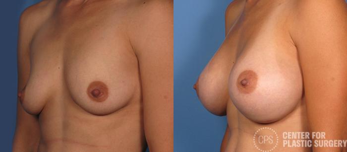 Breast Augmentation Case 83 Before & After Left Oblique | Chevy Chase & Annandale, Washington D.C. Metropolitan Area | Center for Plastic Surgery