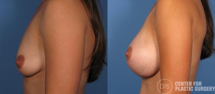 Breast Augmentation Case 83 Before & After Left Side | Chevy Chase & Annandale, Washington D.C. Metropolitan Area | Center for Plastic Surgery