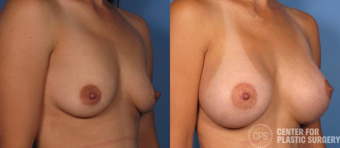 Breast Augmentation Case 83 Before & After Right Oblique | Chevy Chase & Annandale, Washington D.C. Metropolitan Area | Center for Plastic Surgery