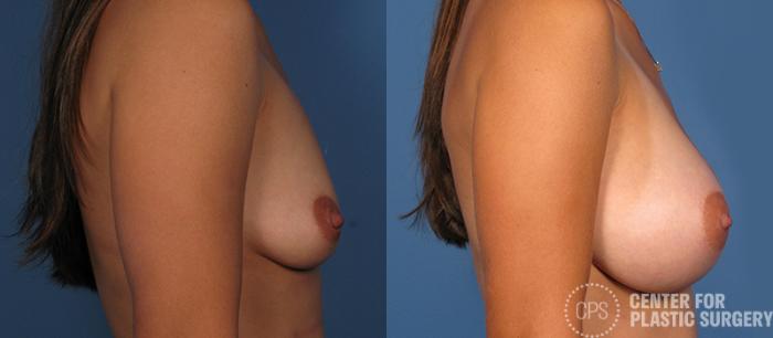 Breast Augmentation Case 83 Before & After Right Side | Chevy Chase & Annandale, Washington D.C. Metropolitan Area | Center for Plastic Surgery