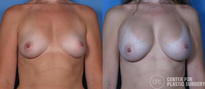Breast Augmentation Case 84 Before & After Front | Chevy Chase & Annandale, Washington D.C. Metropolitan Area | Center for Plastic Surgery