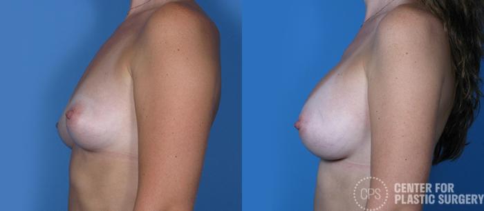 Breast Augmentation Case 84 Before & After Left Side | Chevy Chase & Annandale, Washington D.C. Metropolitan Area | Center for Plastic Surgery