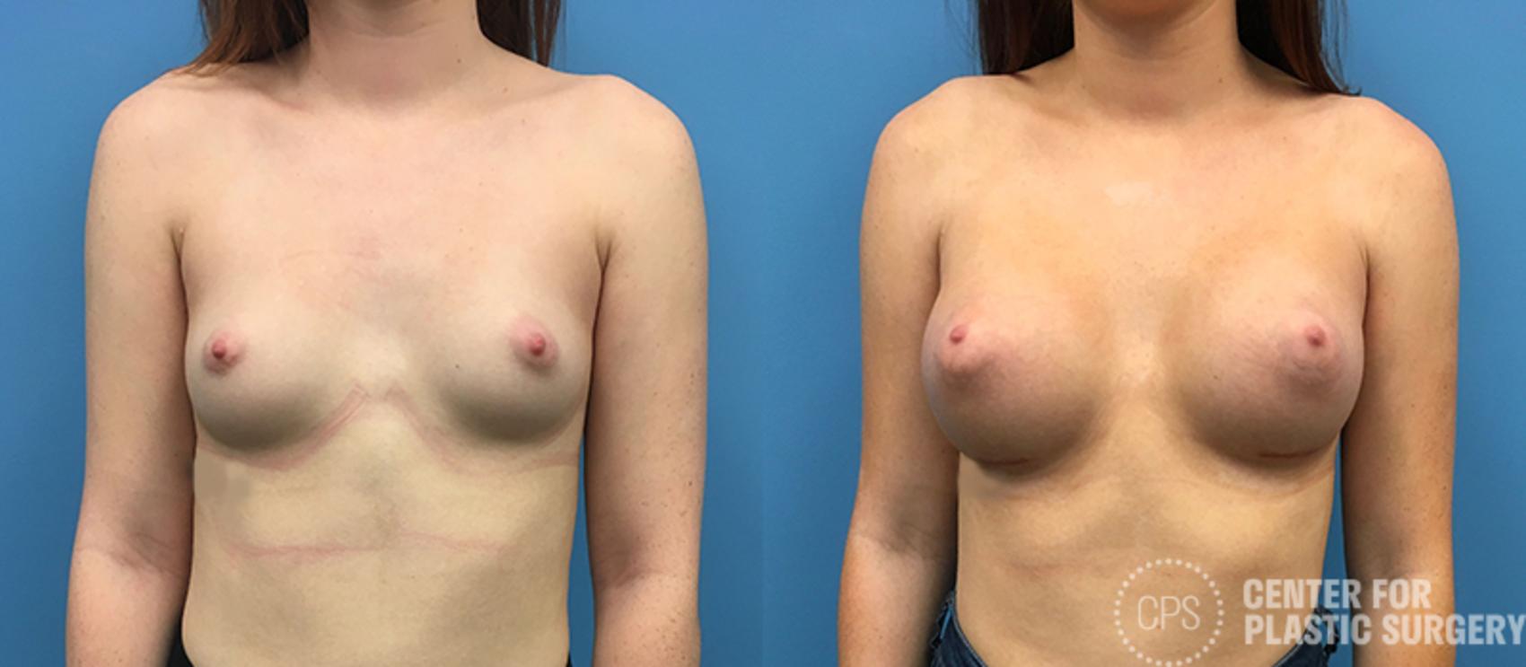 Breast Augmentation Case 85 Before & After Front | Chevy Chase & Annandale, Washington D.C. Metropolitan Area | Center for Plastic Surgery