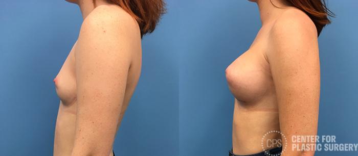 Breast Augmentation Case 85 Before & After Left Side | Chevy Chase & Annandale, Washington D.C. Metropolitan Area | Center for Plastic Surgery