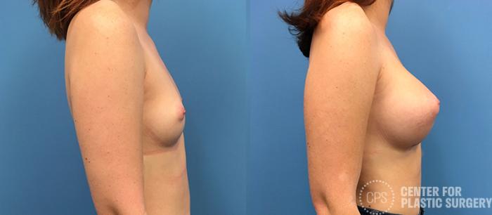 Breast Augmentation Case 85 Before & After Right Side | Chevy Chase & Annandale, Washington D.C. Metropolitan Area | Center for Plastic Surgery