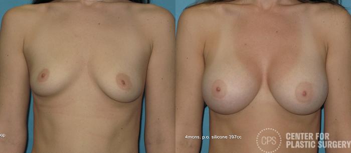 Breast Augmentation Case 86 Before & After Front | Chevy Chase & Annandale, Washington D.C. Metropolitan Area | Center for Plastic Surgery