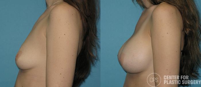 Breast Augmentation Case 86 Before & After Left Side | Chevy Chase & Annandale, Washington D.C. Metropolitan Area | Center for Plastic Surgery