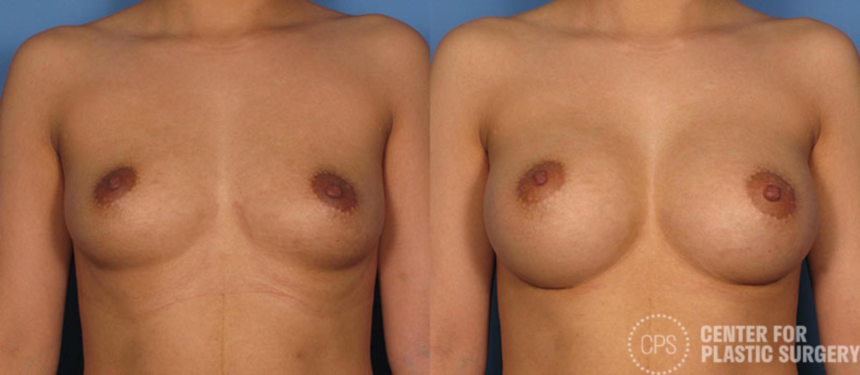 Breast Augmentation Case 87 Before & After Front | Chevy Chase & Annandale, Washington D.C. Metropolitan Area | Center for Plastic Surgery