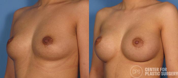 Breast Augmentation Case 87 Before & After Left Oblique | Chevy Chase & Annandale, Washington D.C. Metropolitan Area | Center for Plastic Surgery