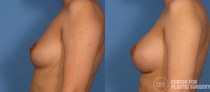 Breast Augmentation Case 87 Before & After Left Side | Chevy Chase & Annandale, Washington D.C. Metropolitan Area | Center for Plastic Surgery