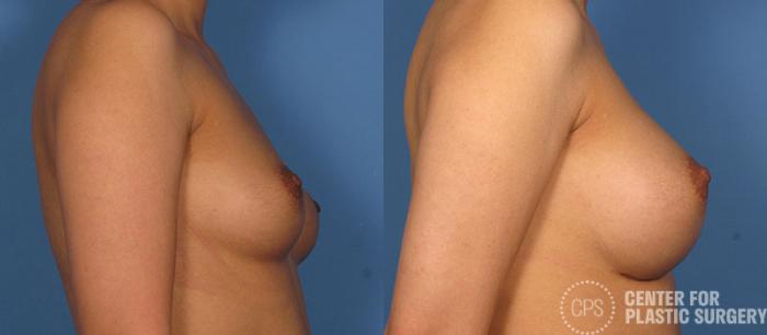 Breast Augmentation Case 87 Before & After Right Side | Chevy Chase & Annandale, Washington D.C. Metropolitan Area | Center for Plastic Surgery