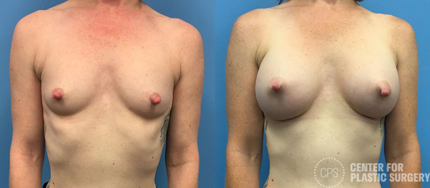 Breast Augmentation Case 88 Before & After Front | Chevy Chase & Annandale, Washington D.C. Metropolitan Area | Center for Plastic Surgery