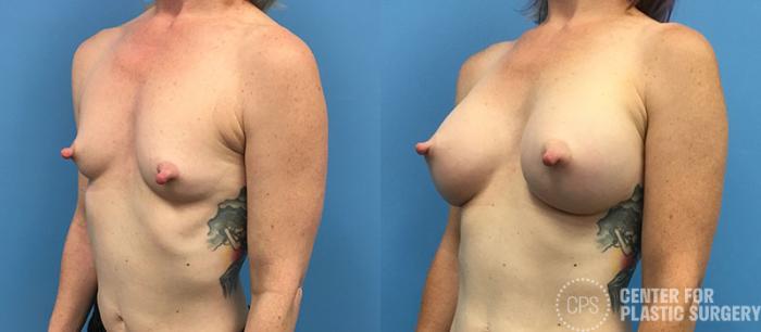 Breast Augmentation Case 88 Before & After Left Oblique | Chevy Chase & Annandale, Washington D.C. Metropolitan Area | Center for Plastic Surgery