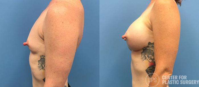 Breast Augmentation Case 88 Before & After Left Side | Chevy Chase & Annandale, Washington D.C. Metropolitan Area | Center for Plastic Surgery