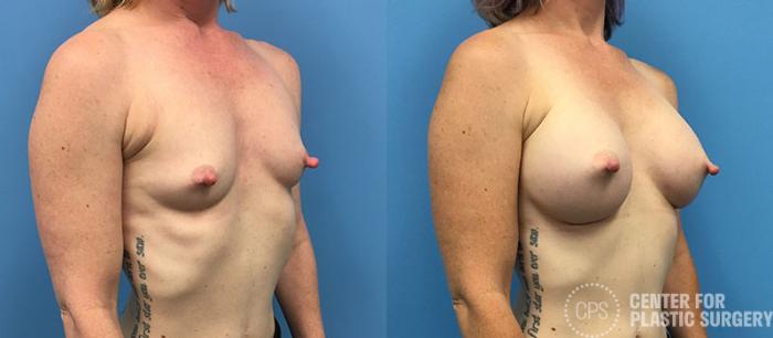 Breast Augmentation Case 88 Before & After Right Oblique | Chevy Chase & Annandale, Washington D.C. Metropolitan Area | Center for Plastic Surgery