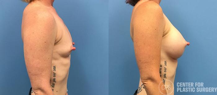 Breast Augmentation Case 88 Before & After Right Side | Chevy Chase & Annandale, Washington D.C. Metropolitan Area | Center for Plastic Surgery