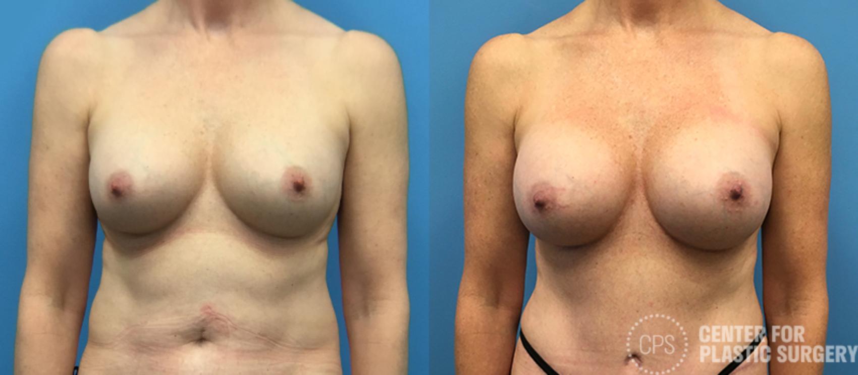Breast Augmentation Case 89 Before & After Front | Annandale, Washington D.C. Metropolitan Area | Center for Plastic Surgery