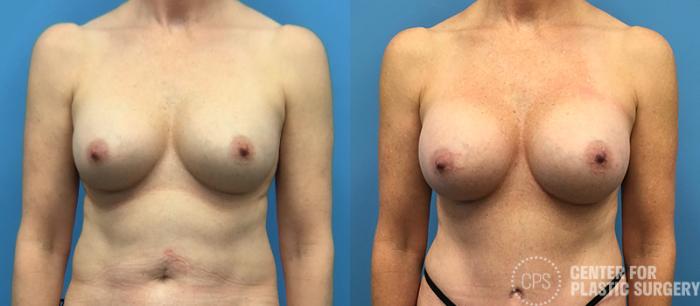Breast Augmentation Case 89 Before & After Front | Chevy Chase & Annandale, Washington D.C. Metropolitan Area | Center for Plastic Surgery