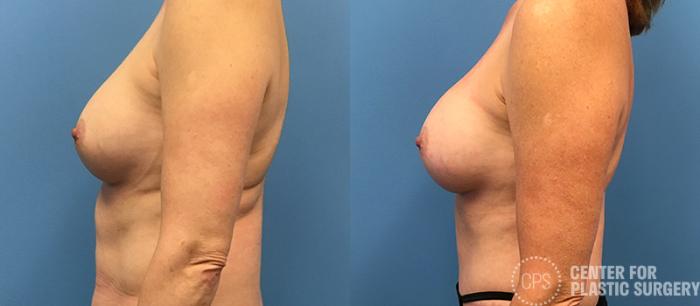Breast Augmentation Case 89 Before & After Left Side | Chevy Chase & Annandale, Washington D.C. Metropolitan Area | Center for Plastic Surgery