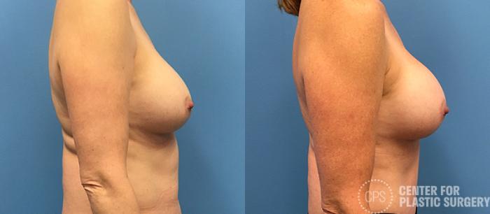 Breast Augmentation Case 89 Before & After Right Side | Chevy Chase & Annandale, Washington D.C. Metropolitan Area | Center for Plastic Surgery